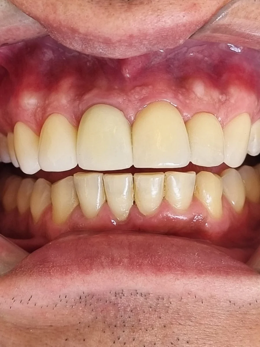Depois — Reabilitação estética