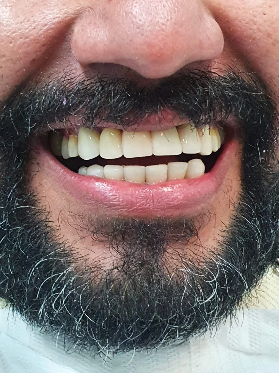 Depois do tratamento