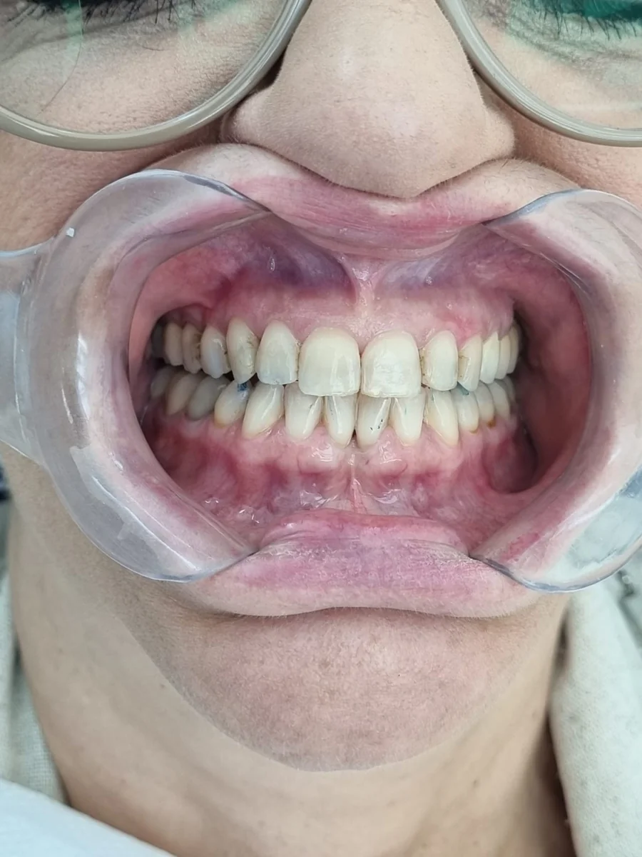 Antes — Clareamento dental